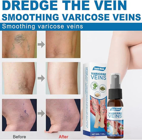 Varicose Veins Spray