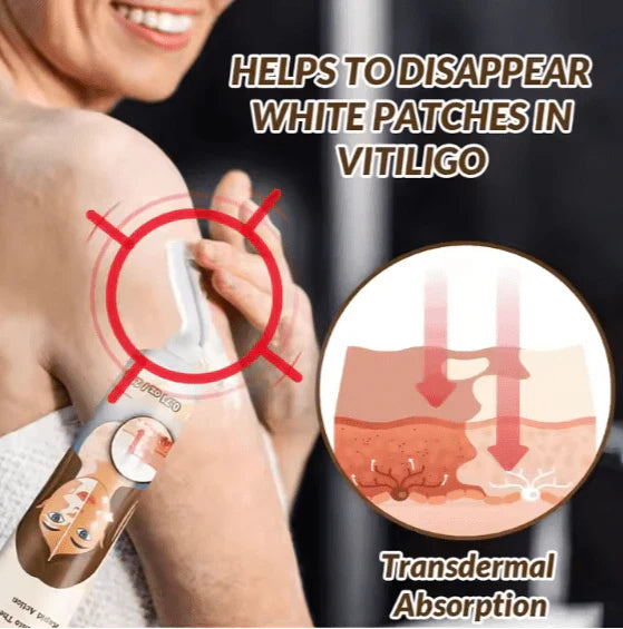 Vitiligo Removal Cream