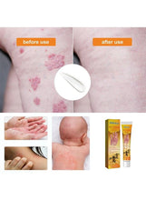 Bee Venom Psoriasis Care Cream
