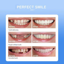 Snap On Smile - Veneer Teeth